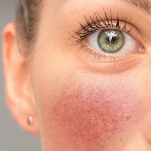 Inflammation Ansikte Hud