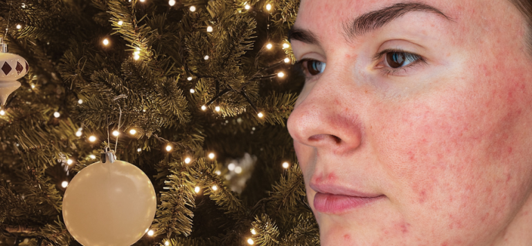 Rosacea hudvård
